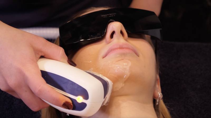 Epilazione laser viso e corpo